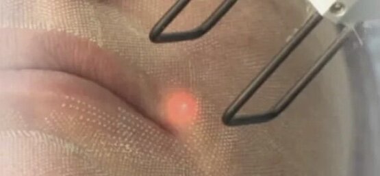 Так выгладит кожа после воздействия лазера (картинка из Internet)