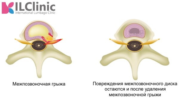 Межпозвоночная грыжа