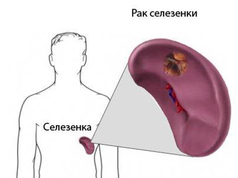 Увеличение селезенки или спленомегалия