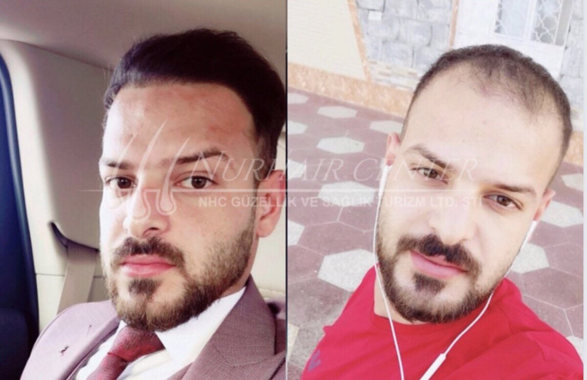 До/после пересадки волос (3800 графтов)