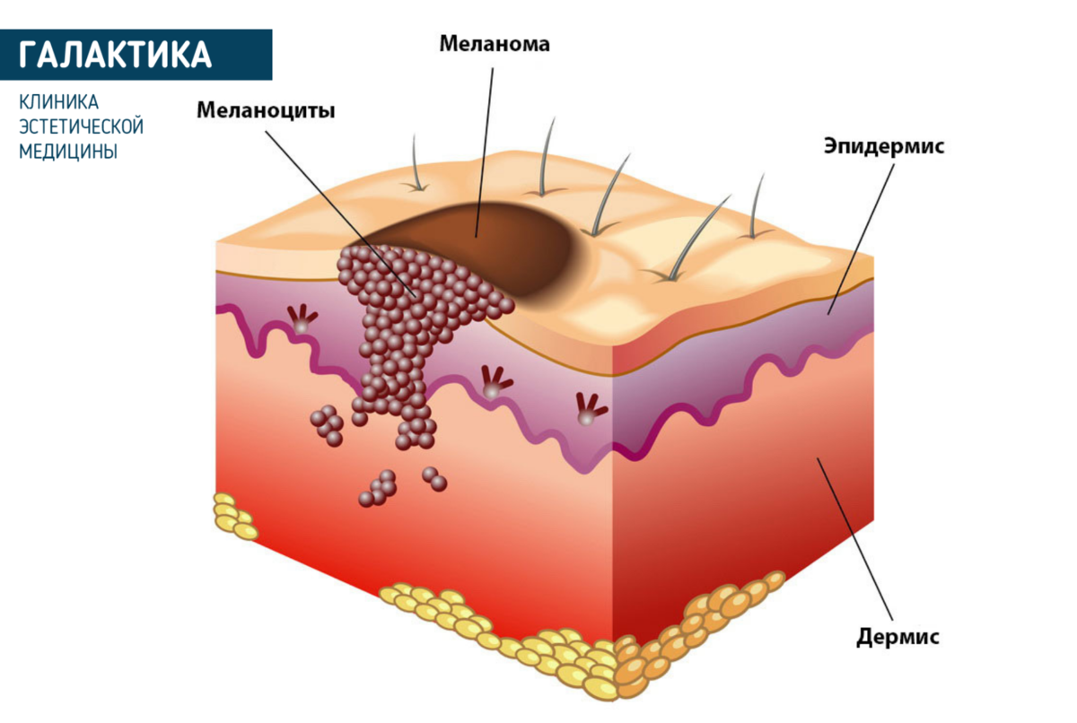 Разные слои. Меланоциты строение. Меланома строение кожи. Слои кожи меланин.