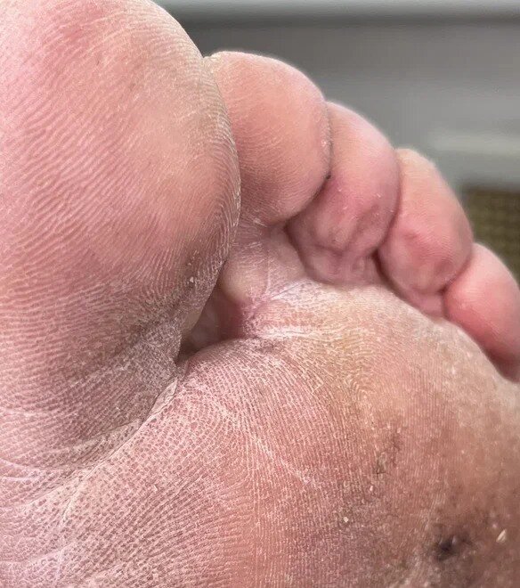 Как выглядит кожа стоп, пораженная микозом