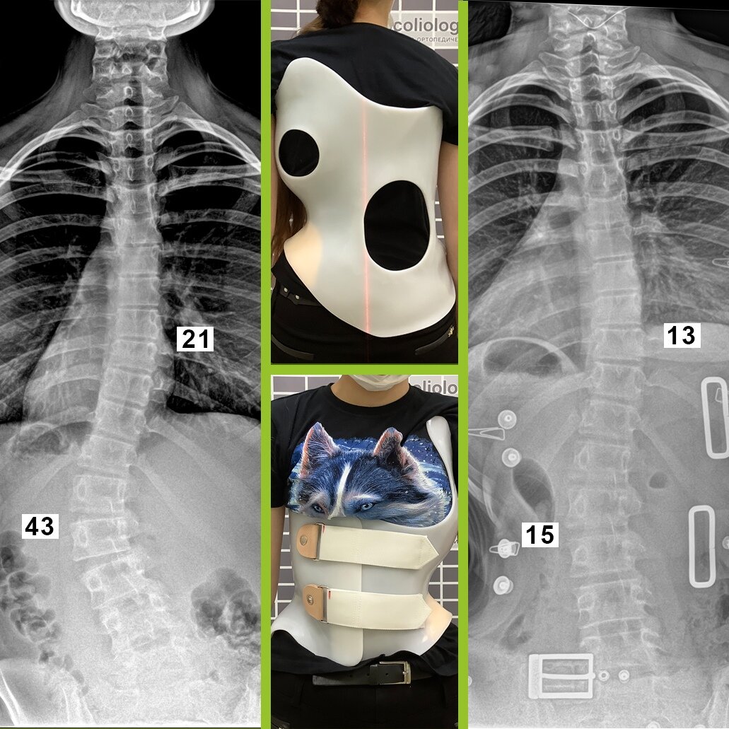 Корсет шено для позвоночника при сколиозе фото