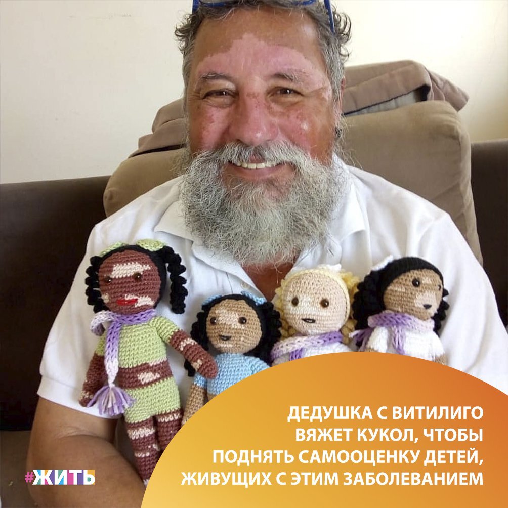 Витилиго — заболевание, которым страдают больше 3 млн жителей Земли. Оно проявляется в отсутствии пигментации на определенных участках тела☝ 
Несмотря на то, что существует немало способов борьбы с этой болезнью, самое сложное для тех, кто страдает витилиго, — сталкиваться с предрассудками окружающих😔

Мы хотим рассказать Вам об одном удивительном дедушке — человеке, который решил использовать искусство вязания крючком, чтобы порадовать и поднять самооценку детей с витилиго - он вяжет кукол, похожих на своих маленьких владельцев❤

Добра этому человеку!

#жить #проектжить #добро #мастерство
