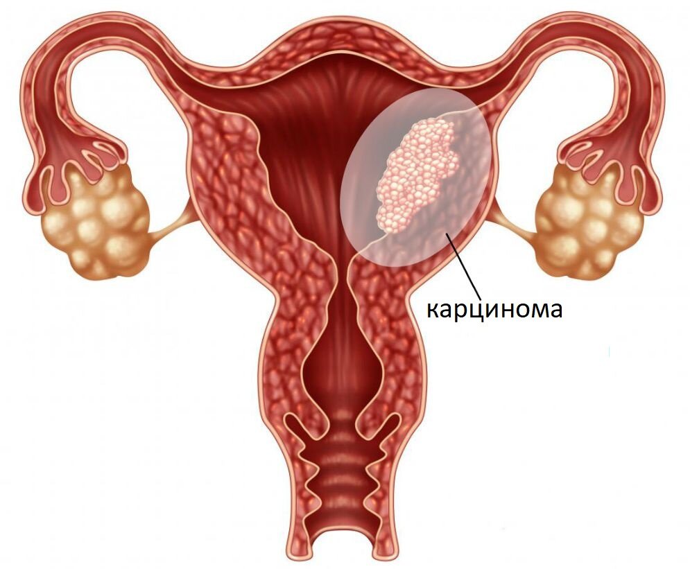 Карцинома матки (схематичное изображение)