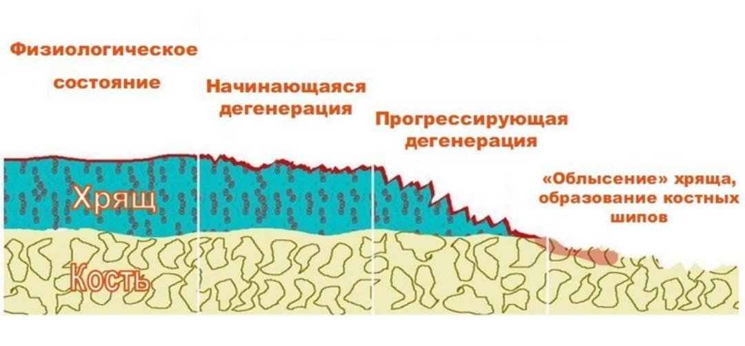 Восстановление хрящевой ткани