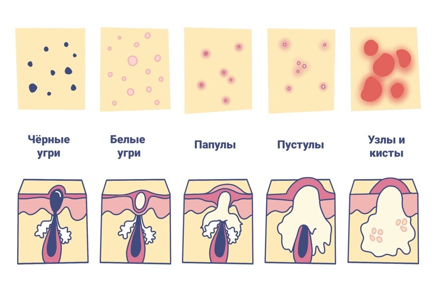 Что делать, если все-таки выдавила прыщ: пошаговая инструкция | theGirl