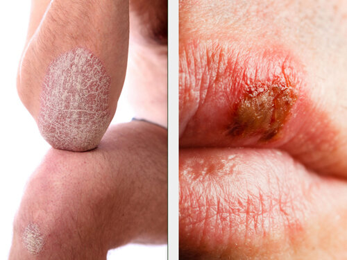 Герпес и псориаз: отличие.