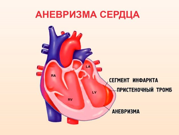 Картине истинной аневризмы в области верхушки миокарда левого желудочка соответствует