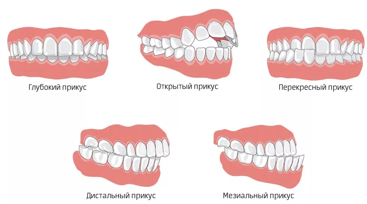 брекети ціна вінниця