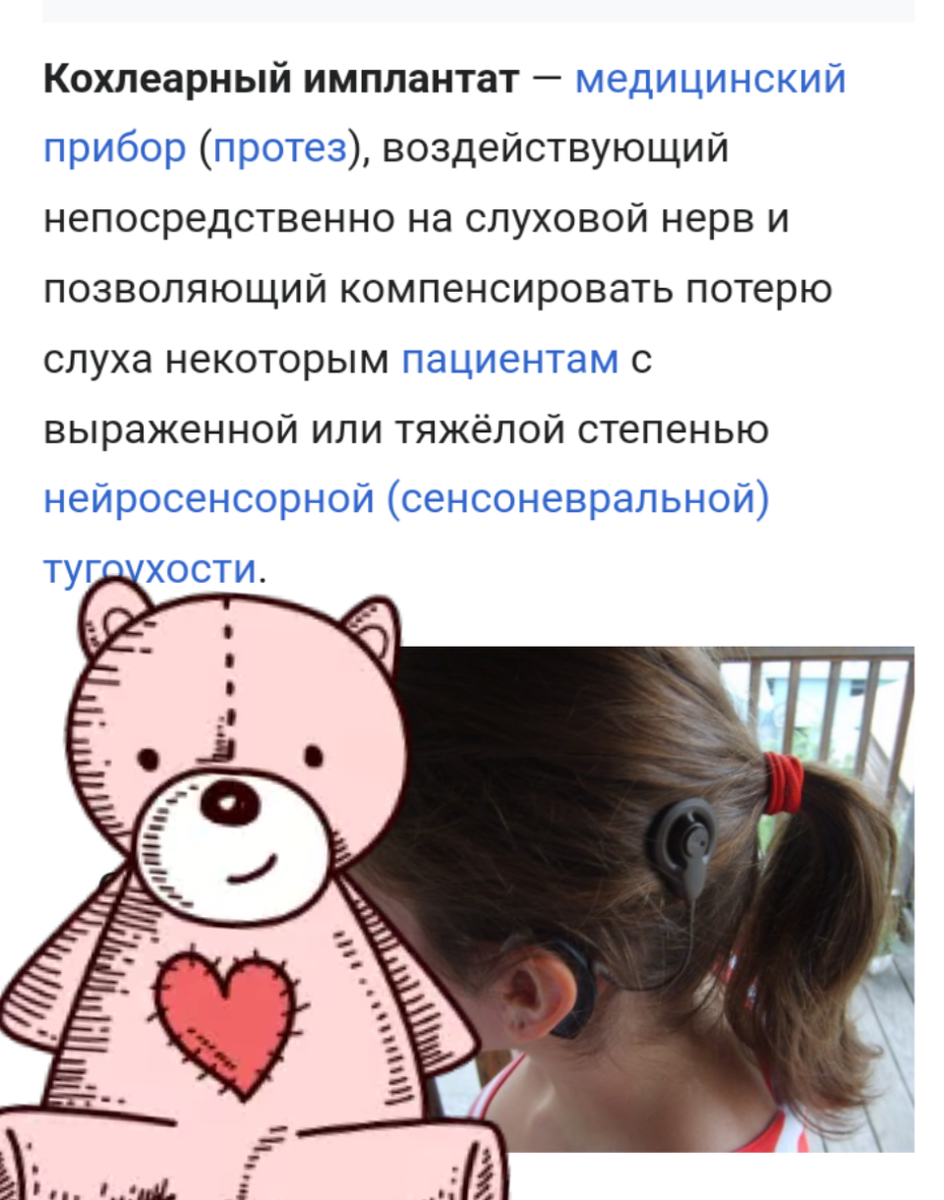 Фото взято с сайта https://diseases.medelement.com/disease/кохлеарная-имплантация-2019/16337#:~:text=Кохлеарная%20имплантация–%20высокотехнологичная%20операция%2C%20в,стимуляции%20сохранившихся%20волокон%20слухового%20нерва