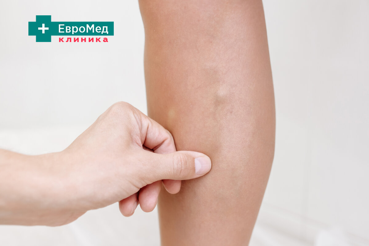 Лечение варикоза немецким лазером за одну процедуру