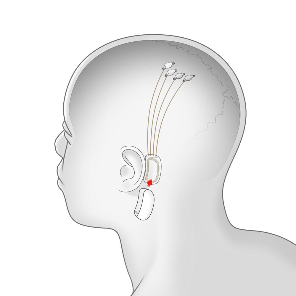 Иллюстрация: Neuralink