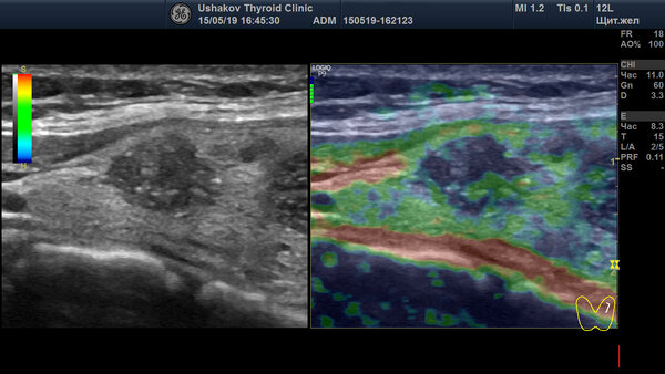 Эластография бесполезна при РАКЕ узлов Щитовидной железы!