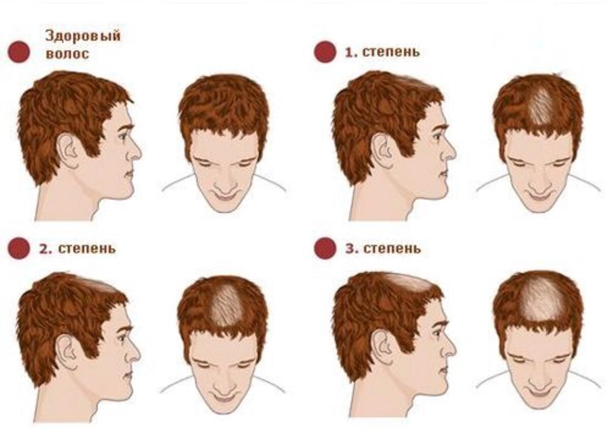 Виды голов у мужчин. Стадии облысения у мужчин. Мужское облысение стадии. Этапы облысения у мужчин.