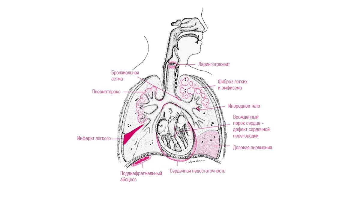 Боль в носу при вдохе. Тяжесть в груди тяжело дышать. Плохо с сердцем тяжело дышать что делать.