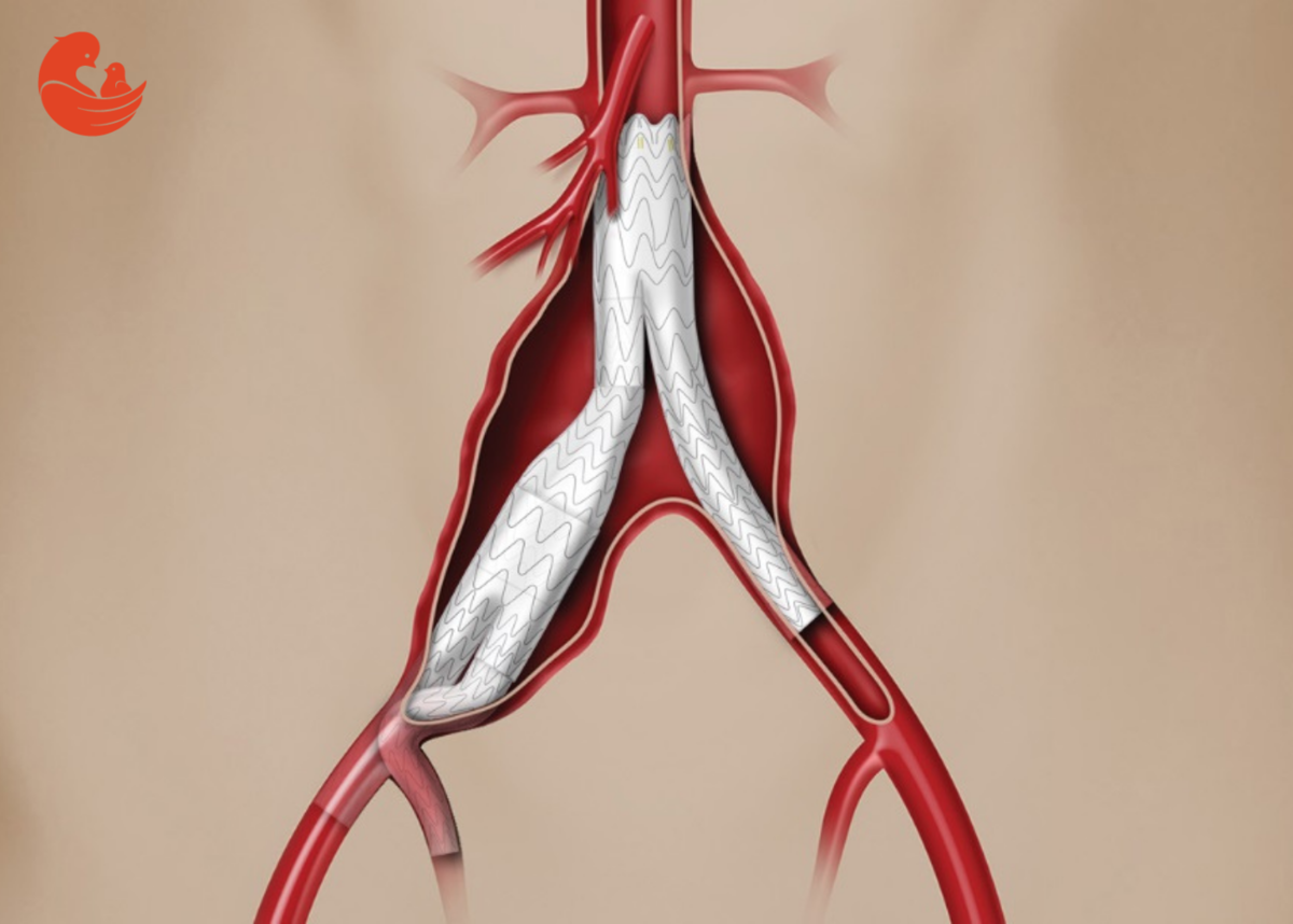 Аневризма стент. Стентирование сосудов эндоваскулярное. Стент брюшной аорты аневризма. Графт-стентирование аорты. Стент графт аорты операция.