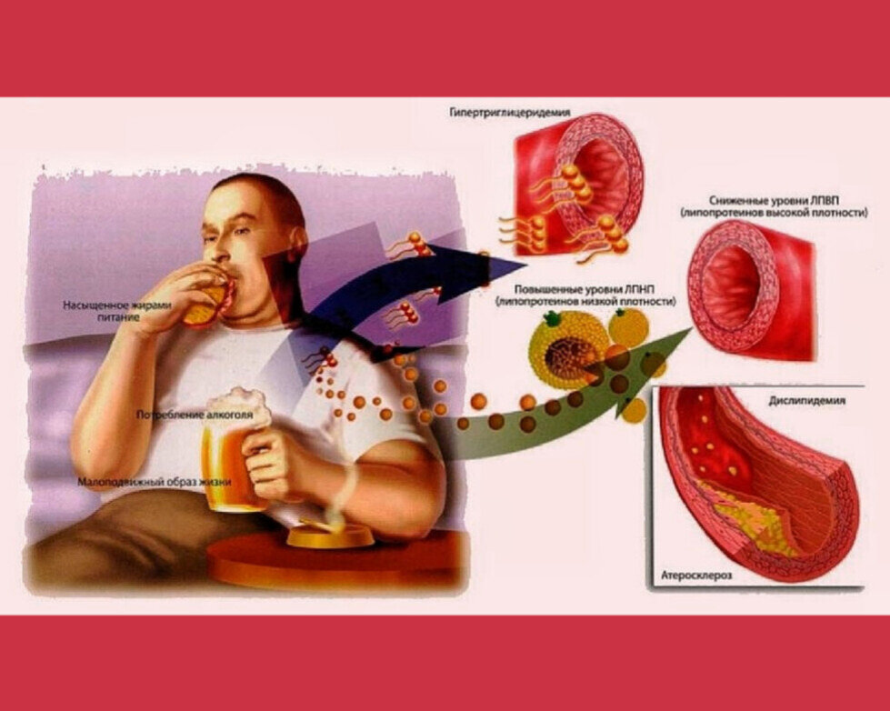 Как снизить уровень холестерина: медикаментозные и немедикаментозные методы