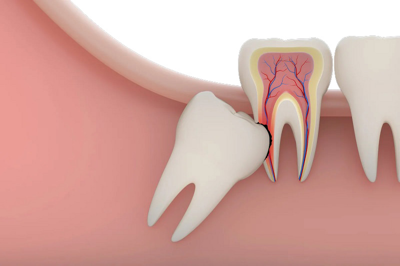 Опухла десна возле зуба: что делать и как лечить проблему максимально эффективными средствами