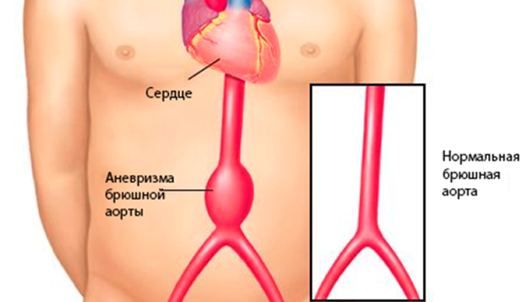 Об аневризме аорты | Неббиоло, медицинский центр