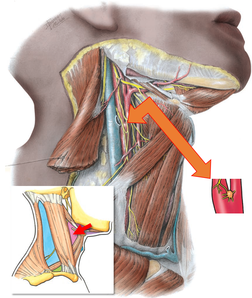 Сонный треугольник (розовый с красной стрелкой ) с обозначенным в нём каротидным синусом (оранжевая стрелка ) Grant's atlas of anatomy/Anne M.R. Agur, Arthur F. Dalley II.—12th ed