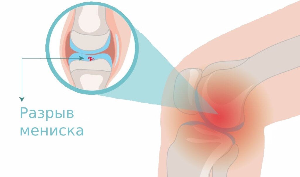 Повреждение менисков коленного сустава