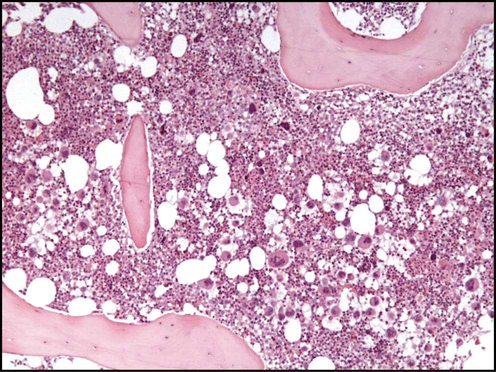 Костный мозг, пораженный фиброзом. Источник: Terapevticheskii arkhiv