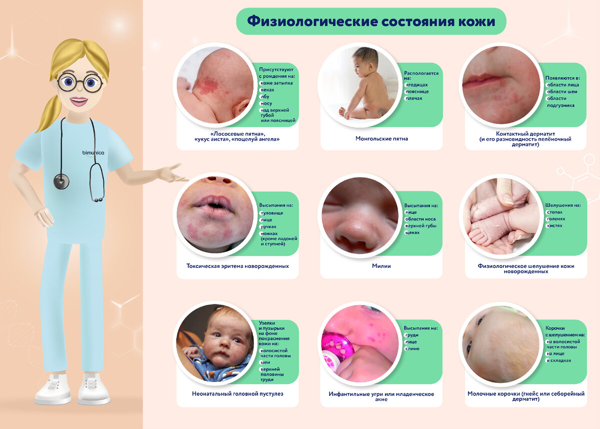 Акне новорожденных и все, что необходимо знать об этом — Allergika (Аллергика) Украина