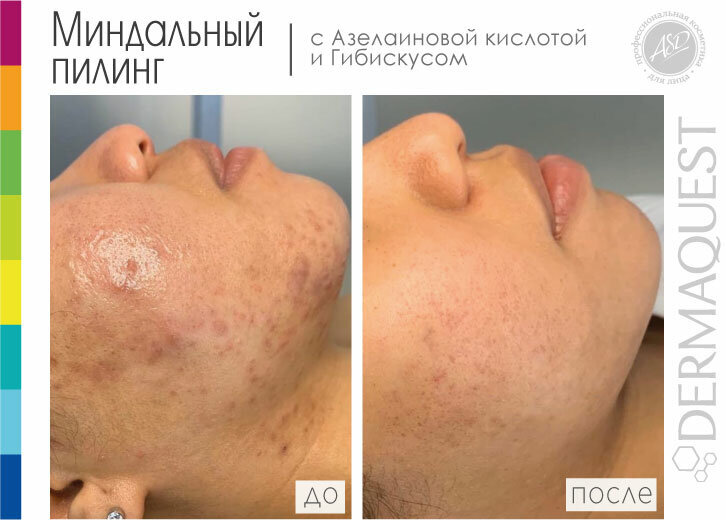 Результат после 5 процедур Миндального пилинга DermaQuest: регресс высыпаний на 90%, нормализация количества и состава кожного сала, отсутствие блеска и комедонов, выравнивание тона кожи.