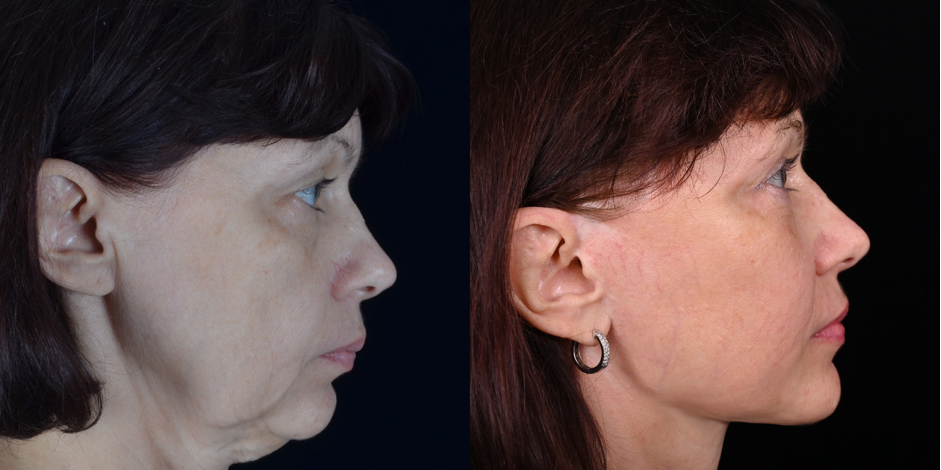Для коррекции возрастных изменений выполнены подтяжка лица и шеи (пластизмопластика)