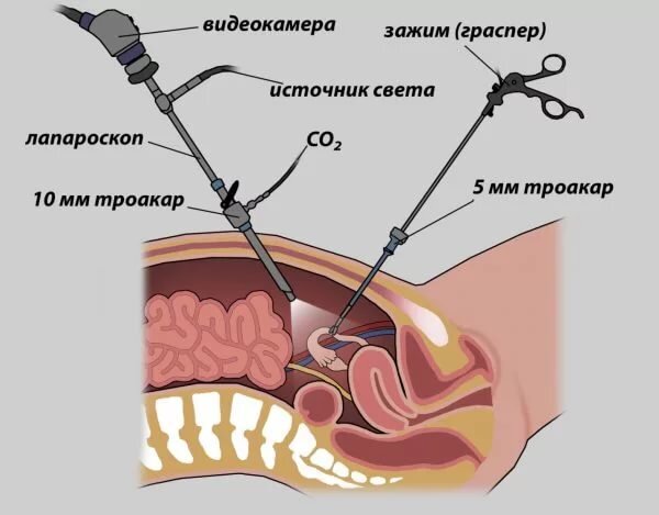 Лапароскоп