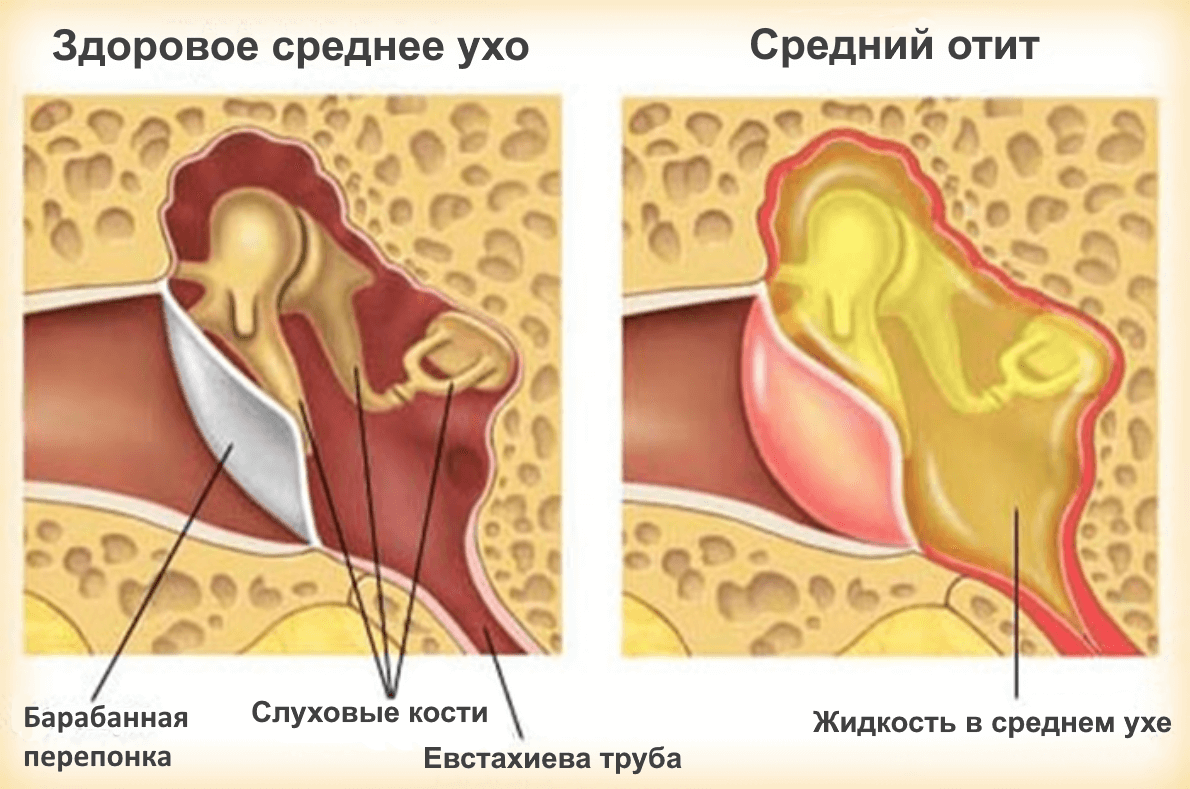 Болит ухо у взрослого что делать