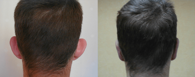 Отопластика "до и после".  Фото с сайта Д.Р. Гришкяна. Имеются противопоказания, требуется консультация специалистов