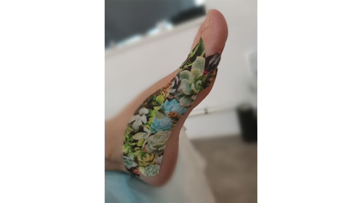 Фото аппликации терапевтического тейпирования у пациента