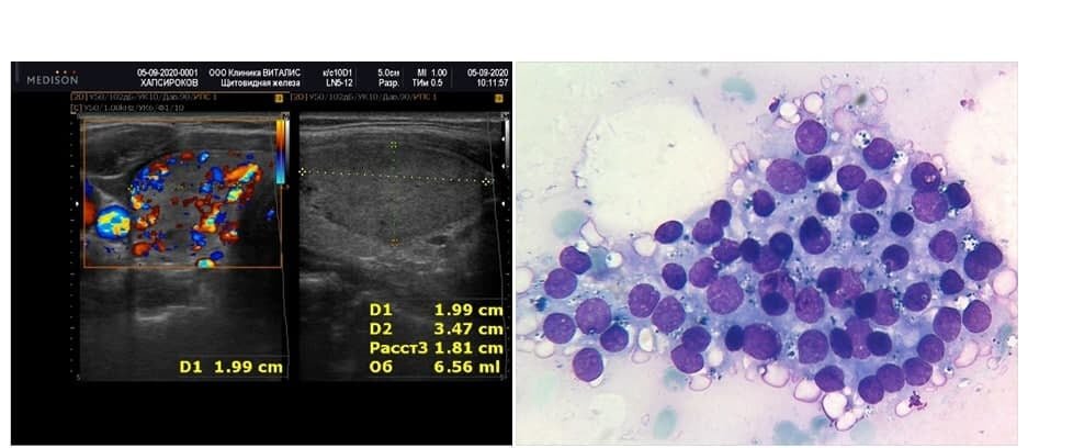 ЗАМЕТКИ КЛИНИЧЕСКОГО ЦИТОЛОГА. БЕТЕСДА II: КИСТОЗНЫЙ КОЛЛОИДНЫЙ УЗЕЛ ...