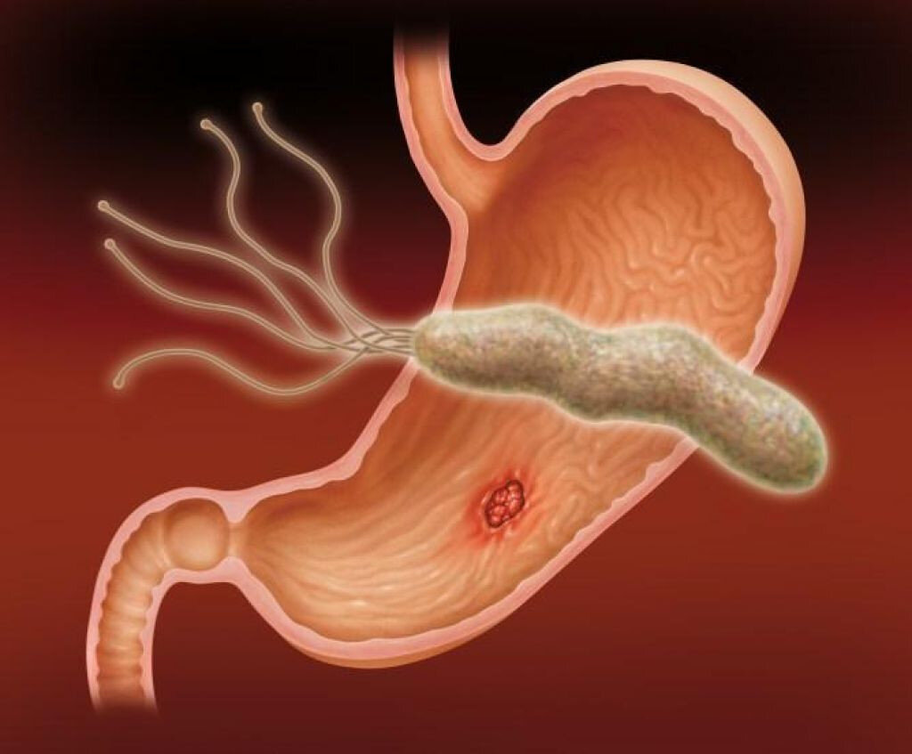 Болезнь желудка и двенадцатиперстной кишки. Язва 12 перстной кишки вызванная хеликобактер пилори. Хеликобактер пилори яб.