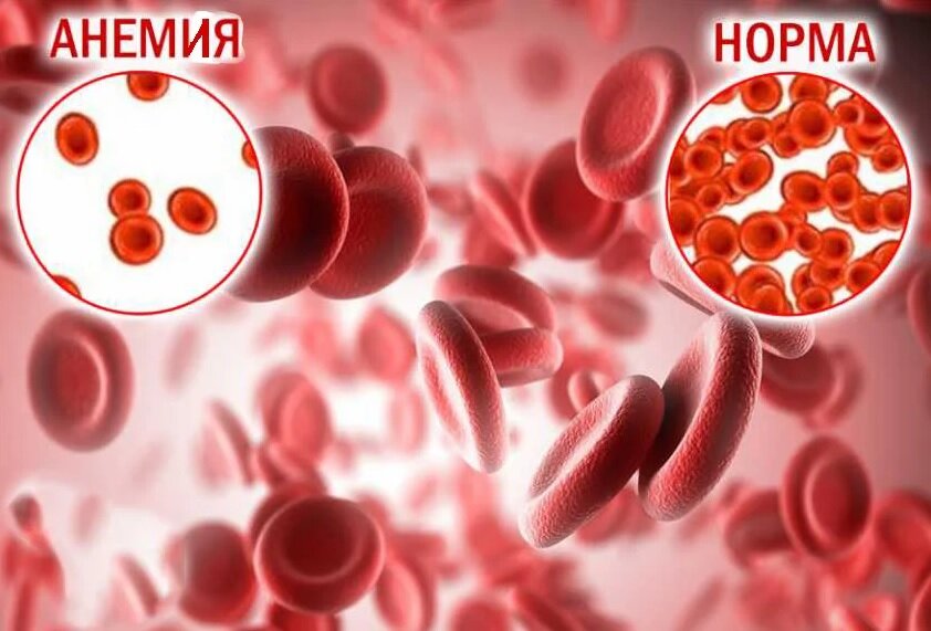 Анемия — это состояние, для которого характерно снижение количества эритроцитов