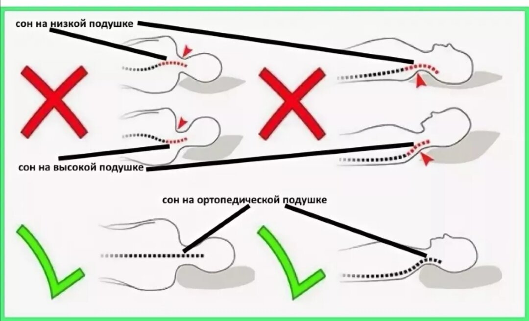 Остеохондроз спать без подушки