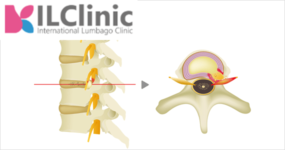 Мифы о последствиях грыжи позвоночника