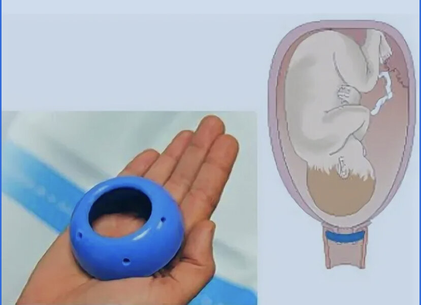 Пессарий доктор арабин. Кольцо для беременных на шейку матки. Акушерское кольцо пессарий. Гинекологический пессарий арабин. Пессарий арабин.