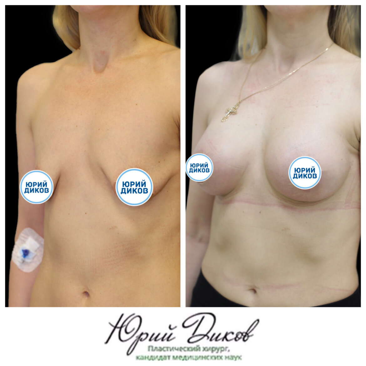 тубулярная деформация груди у женщин фото 23