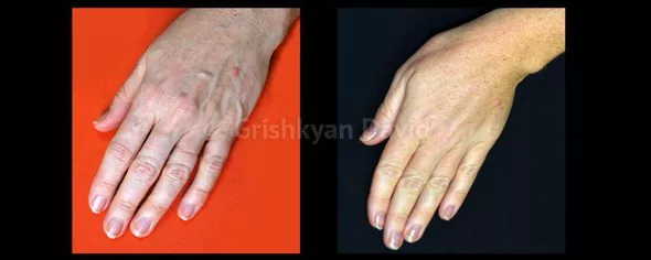 Липофилинг рук фото до и после. Фото с сайта Д.Р. Гришкяна. Имеются противопоказания, требуется консультация специалиста