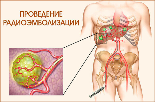 Радиоэмболизация метастазов в печени