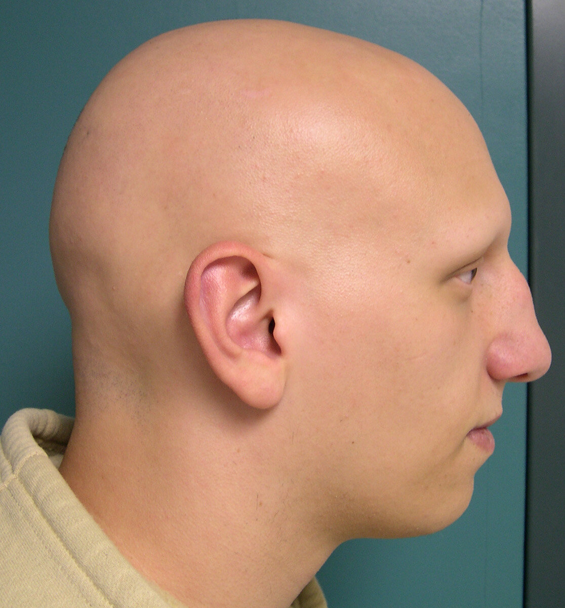 Кривой лоб. Необычная форма головы.
