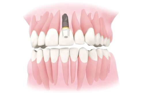 Имплантация передних верхних зубов
