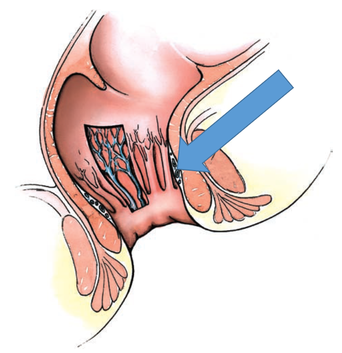 Рис. 1. Геморроидальные узлы в анальном канале. (Grant's atlas of anatomy/Anne M.R. Agur, Arthur F. Dalley II.—12th ed. )