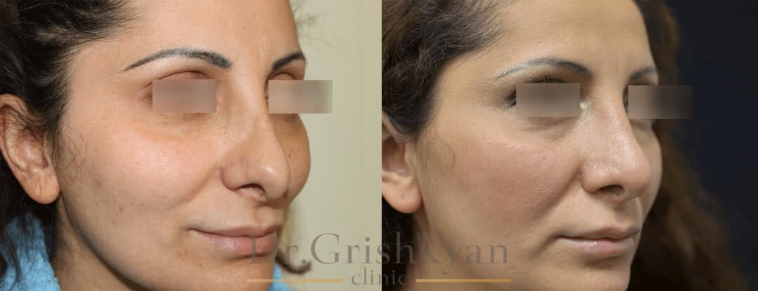 Повторная ринопластика носа фото до и после. Фото с сайта Д.Р. Гришкяна. Имеются противопоказания, требуется консультация специалиста