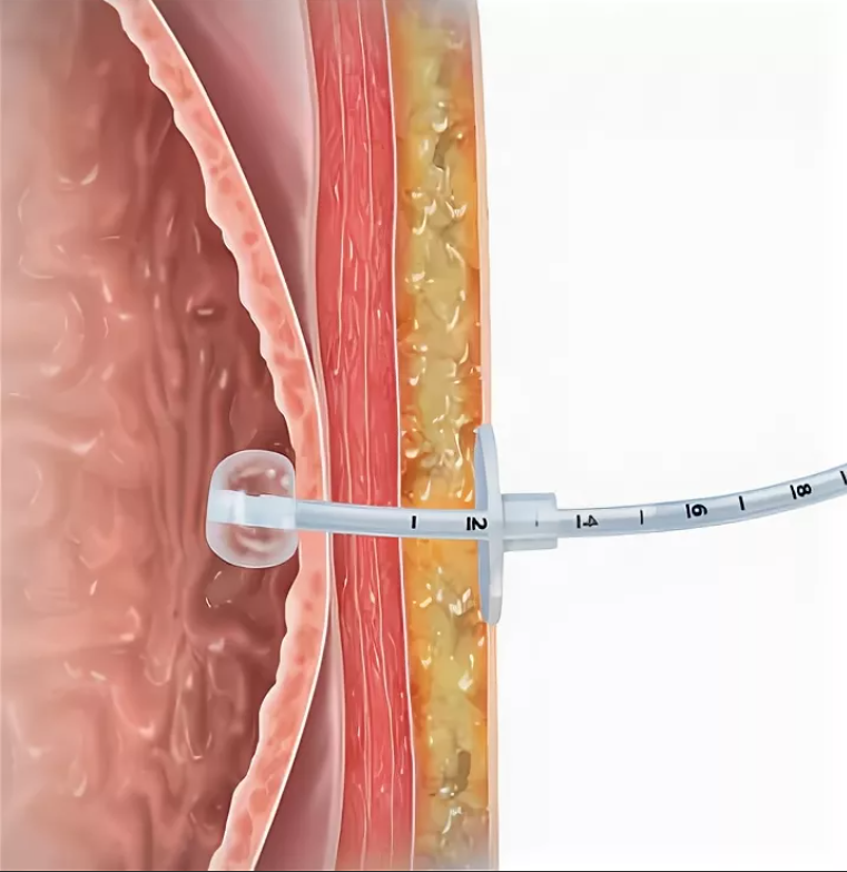 Чрескожная гастростомия. Гастростомия feeding tube. Кольцевые прокладки вокруг гастростомы.