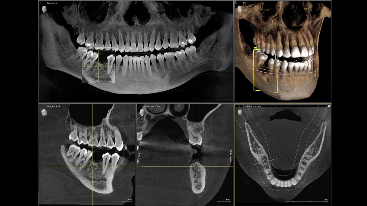 Снимок 3. Кт зубов 3д Сирона. Кт снимки зубов Sirona. Компьютерная томография зубов и челюсти – снимок 3d.