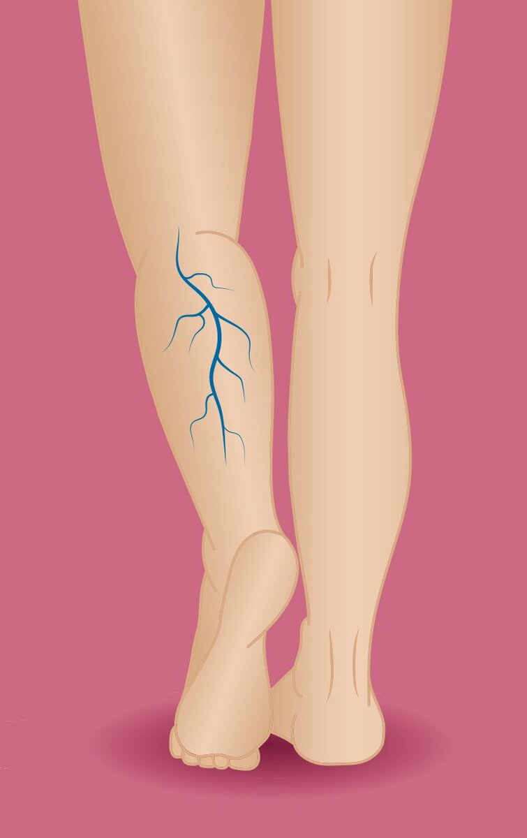 Варикозное расширение вен нижних конечностей